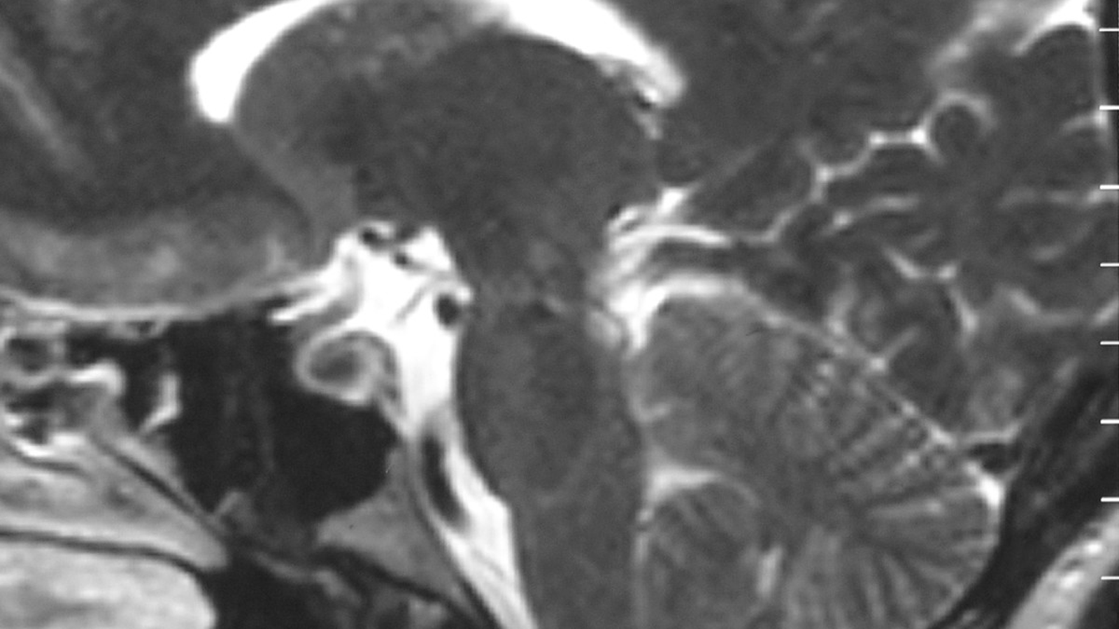 סריקת MRI בחתך צד של המוח, עם חץ לבן המצביע על אזור סמוך לגזע המוח, מלווה מאמר של ד״ר גיא רופא
